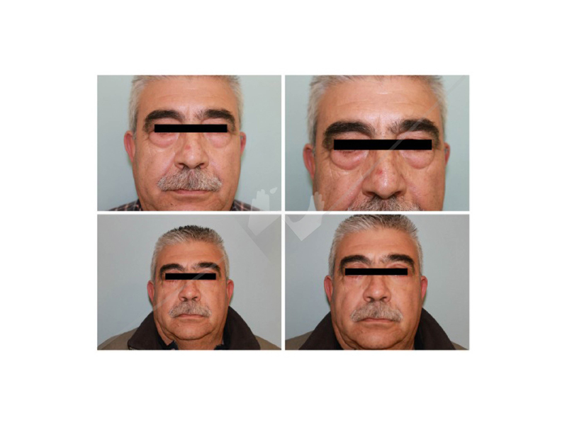 blefaroplastia1_1