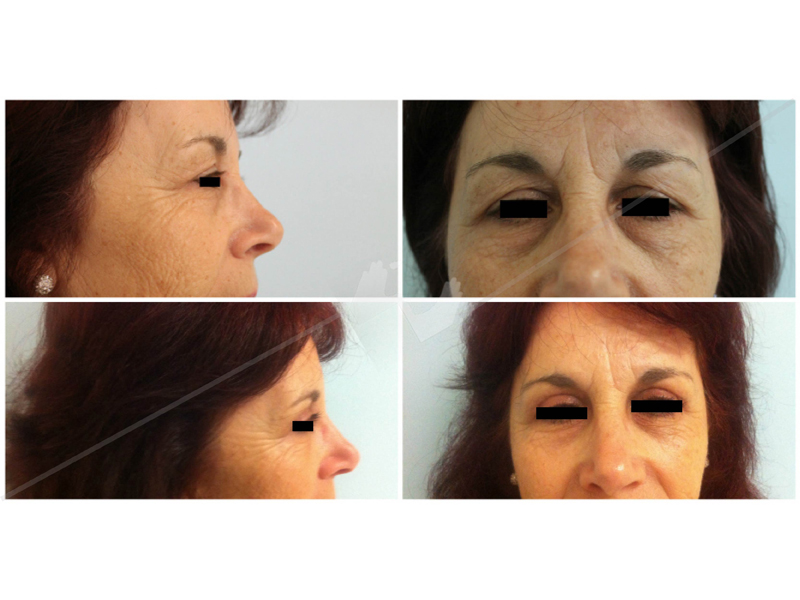 blefaroplastia1_2