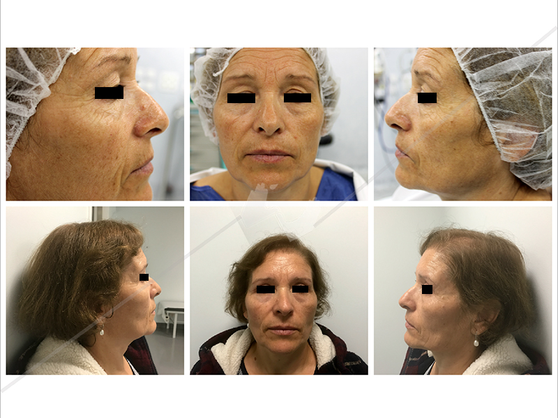 blefaroplastia_3
