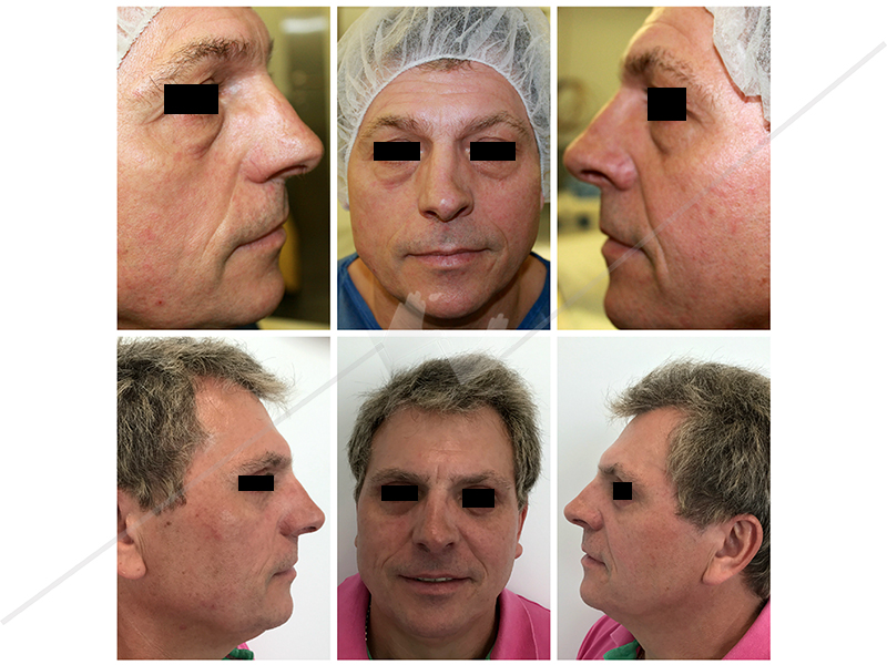 blefaroplastia_4