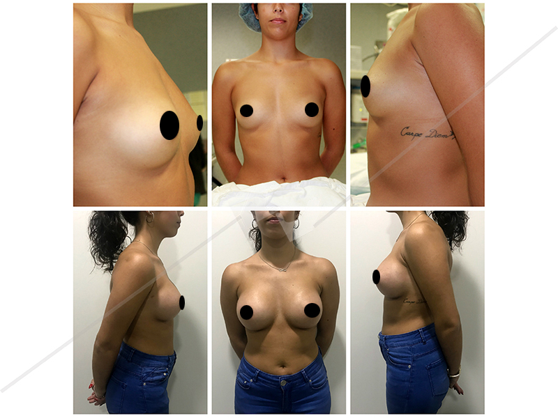 mamoplastia_1