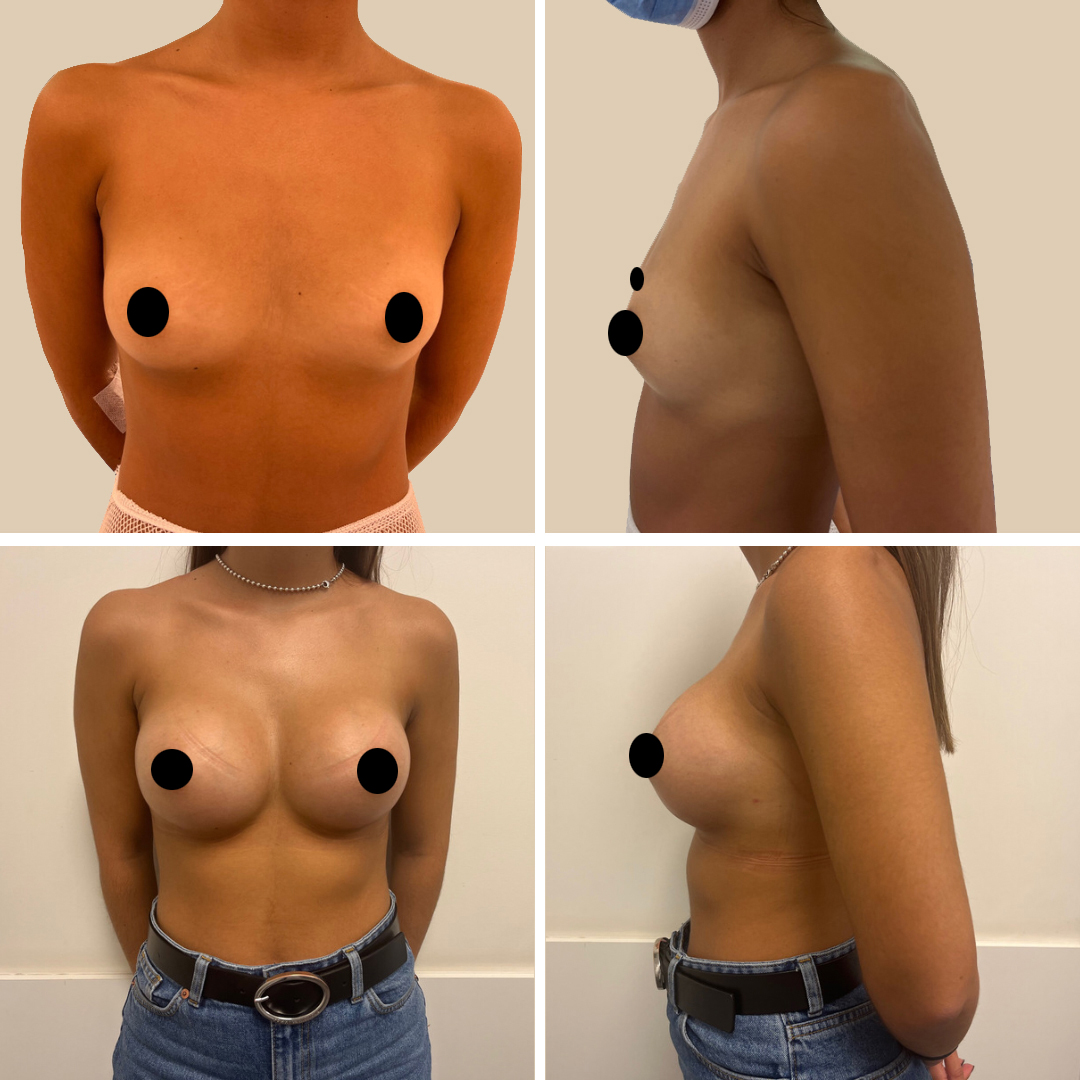 mamoplastia_10