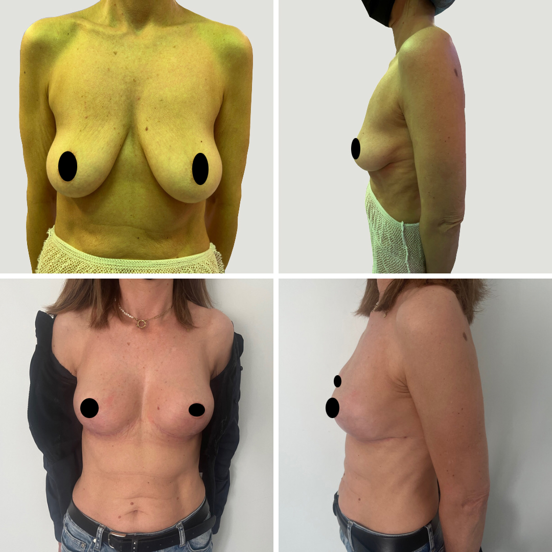 mamoplastia_11