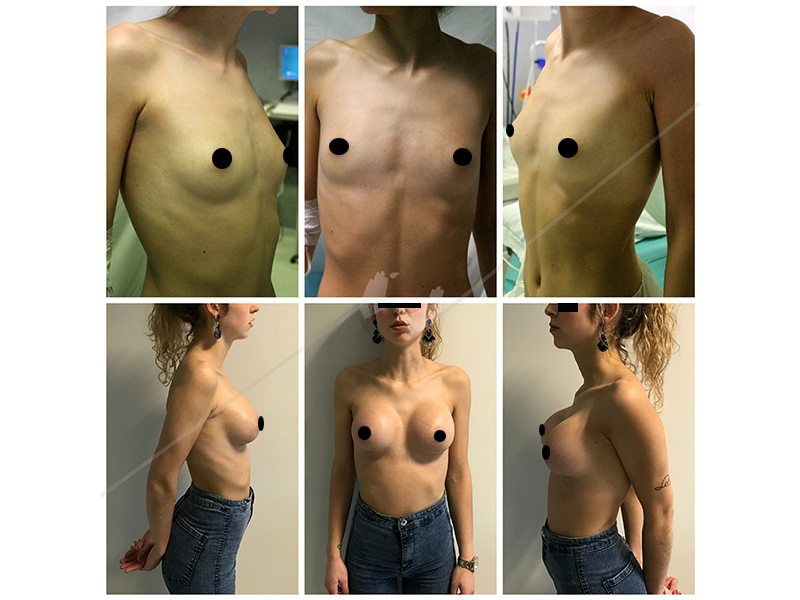 mamoplastia_4
