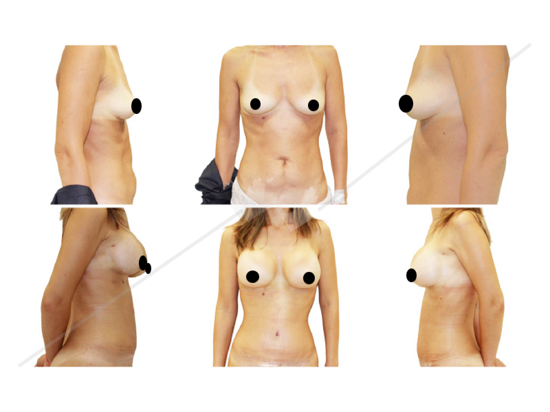 mamoplastia1_4