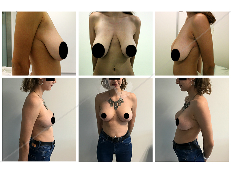 mamoplastia_7