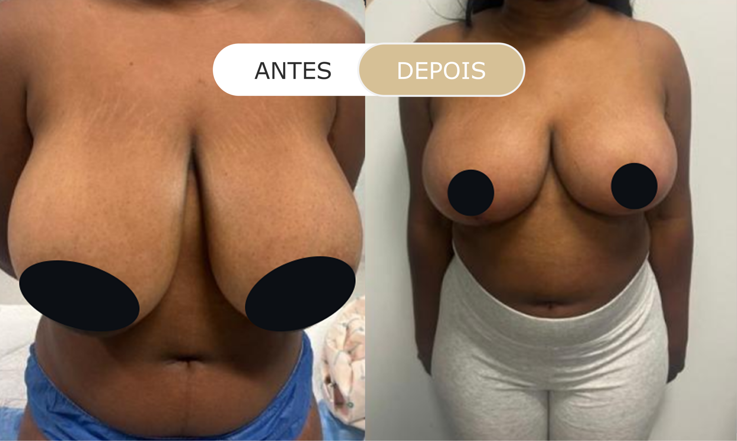 antes e depois - 11