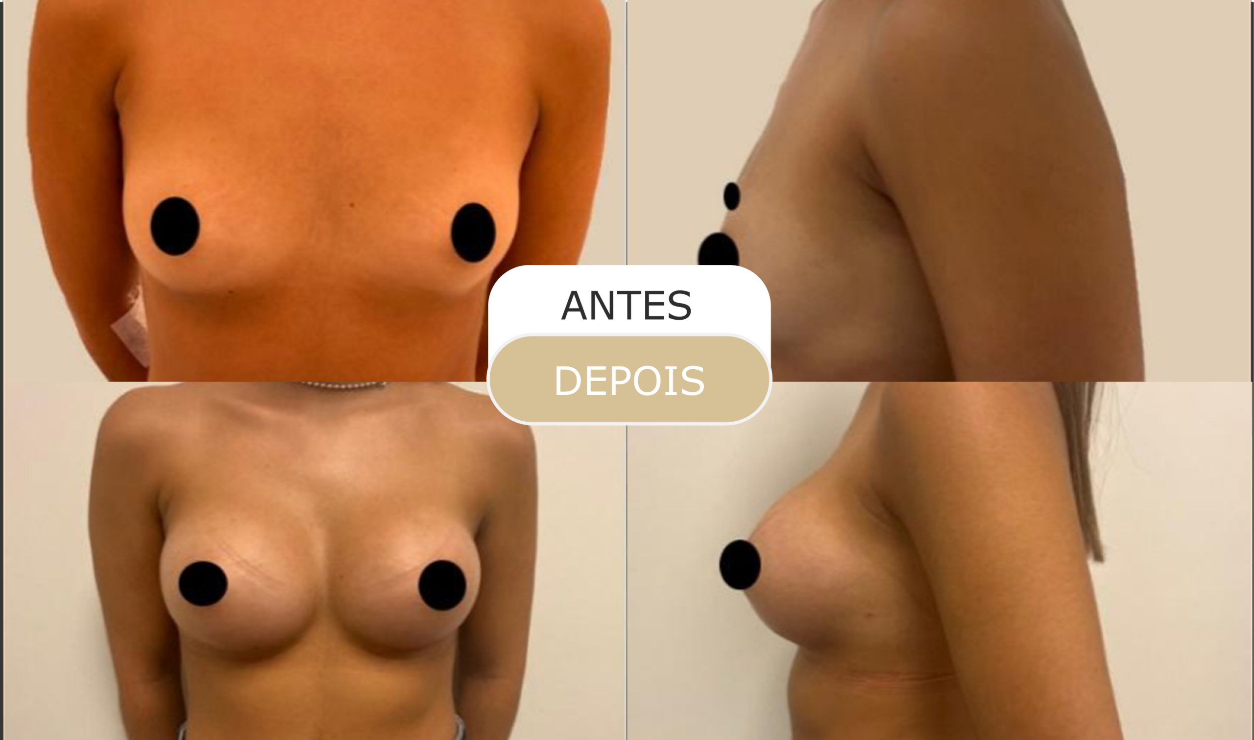 antes e depois - 14