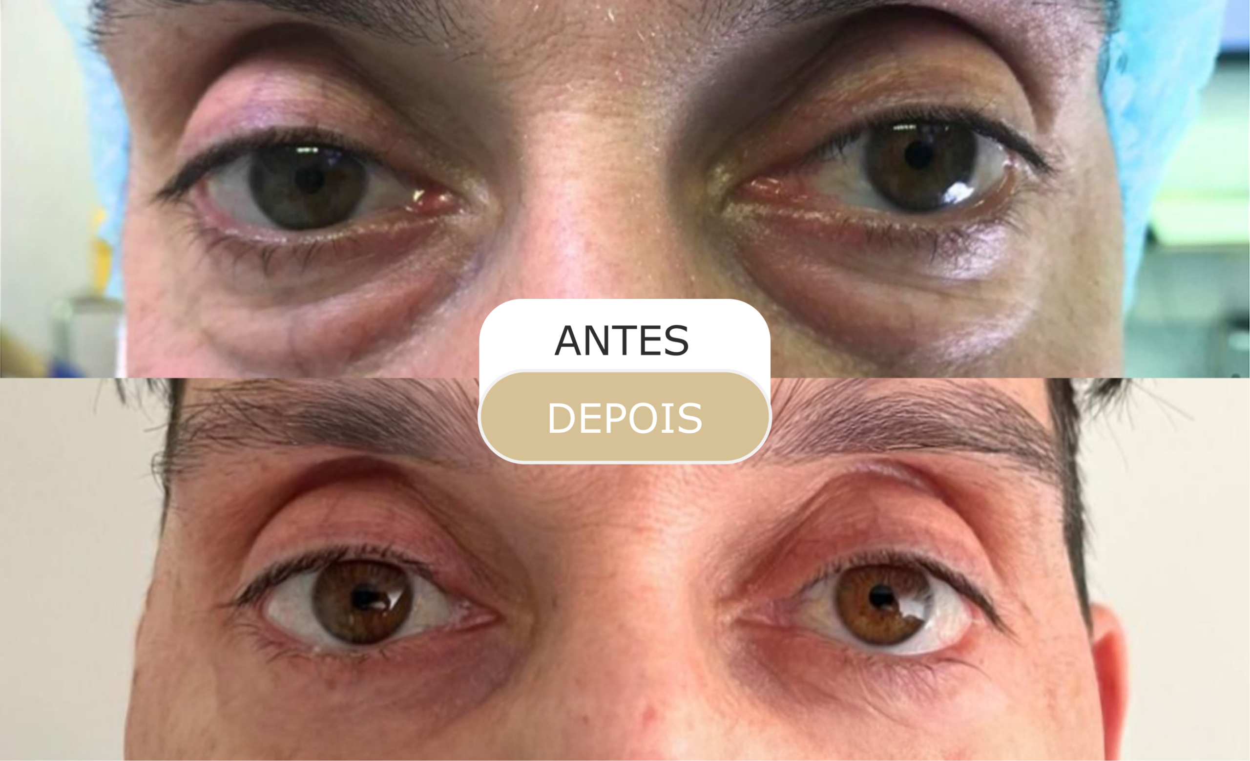 Home 32 antes e depois - 26