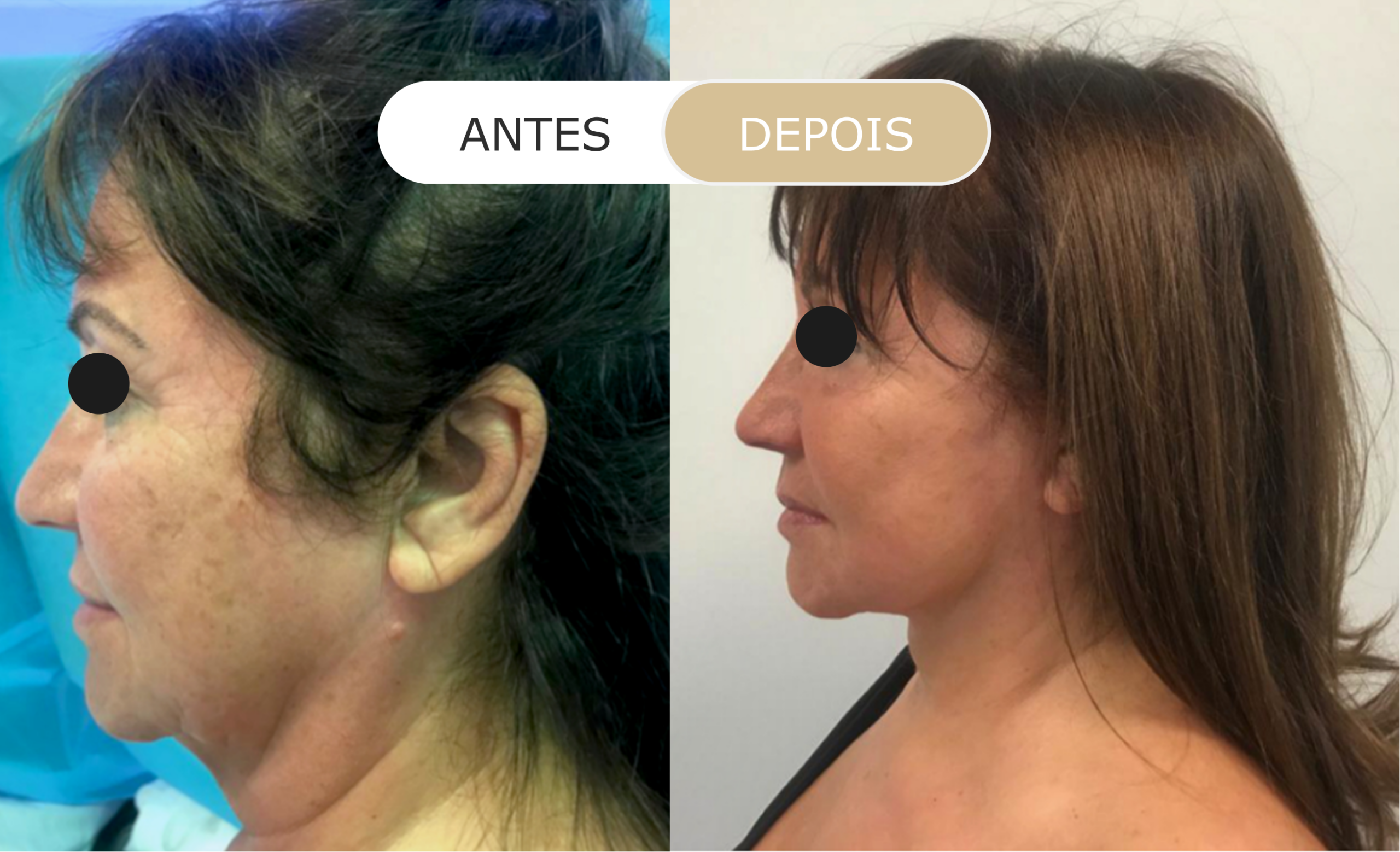 Home 14 antes e depois - 29