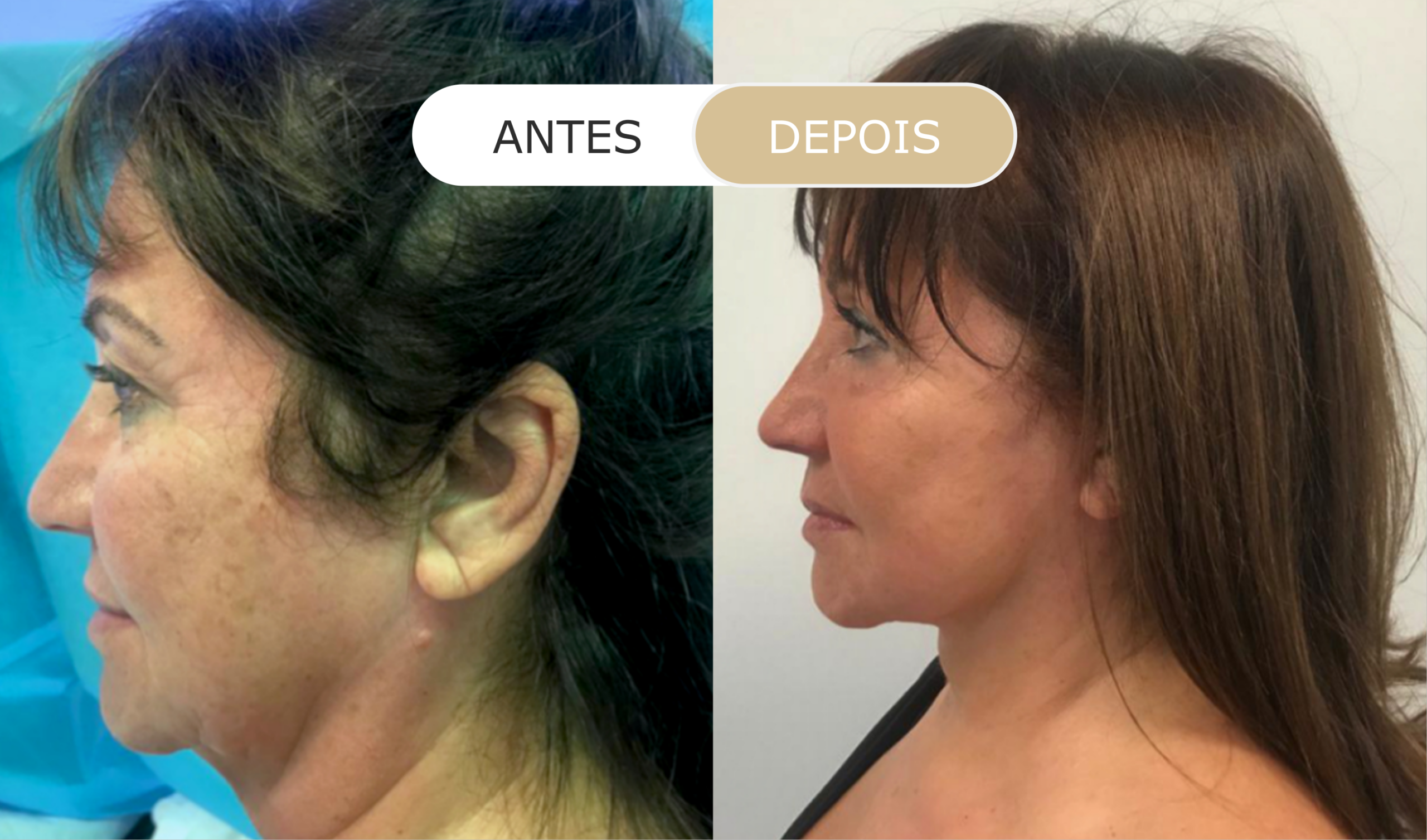 antes e depois - 29