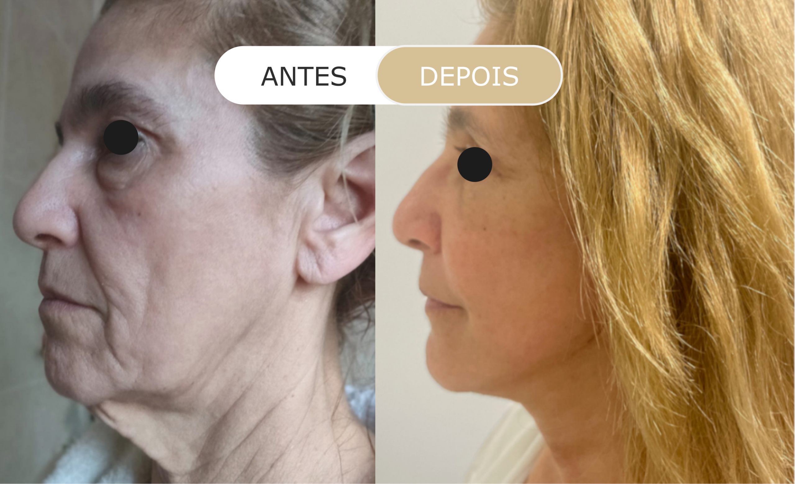 Home 15 antes e depois - 30