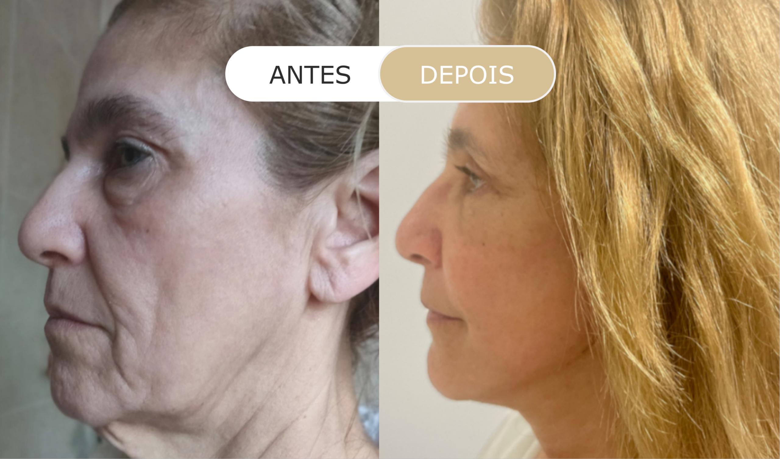 antes e depois - 30