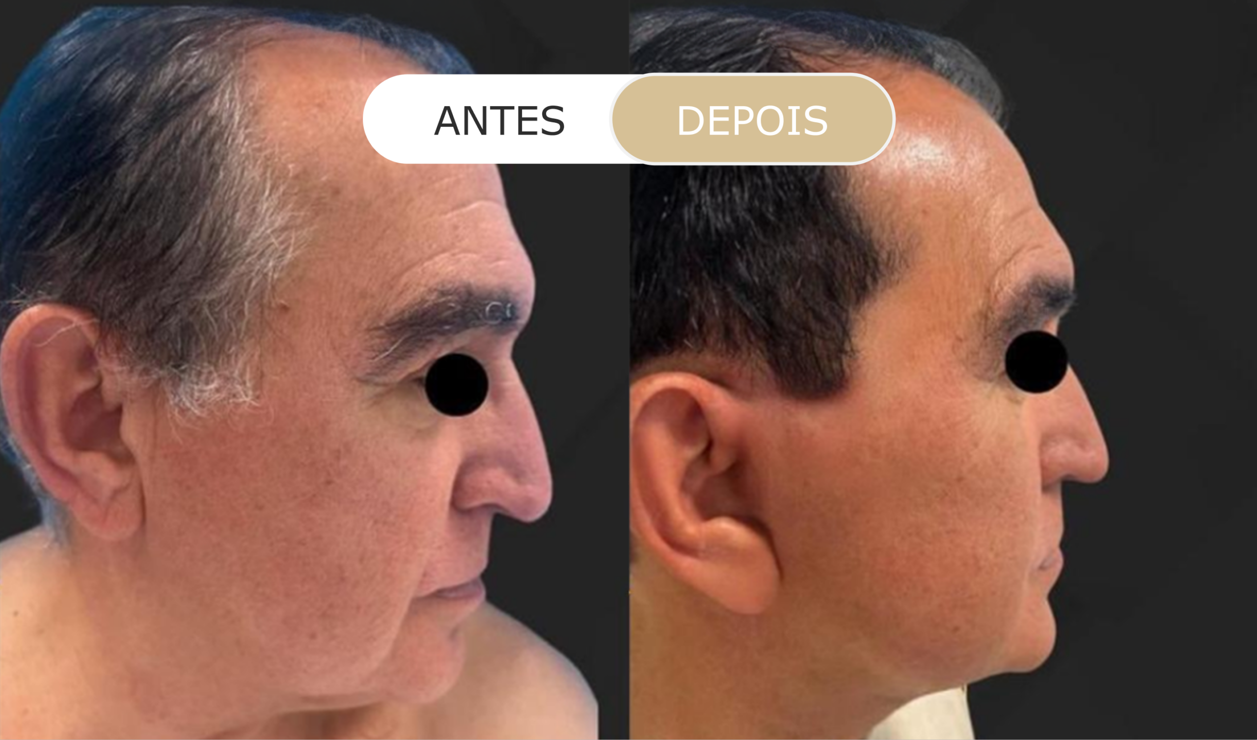 antes e depois - 31