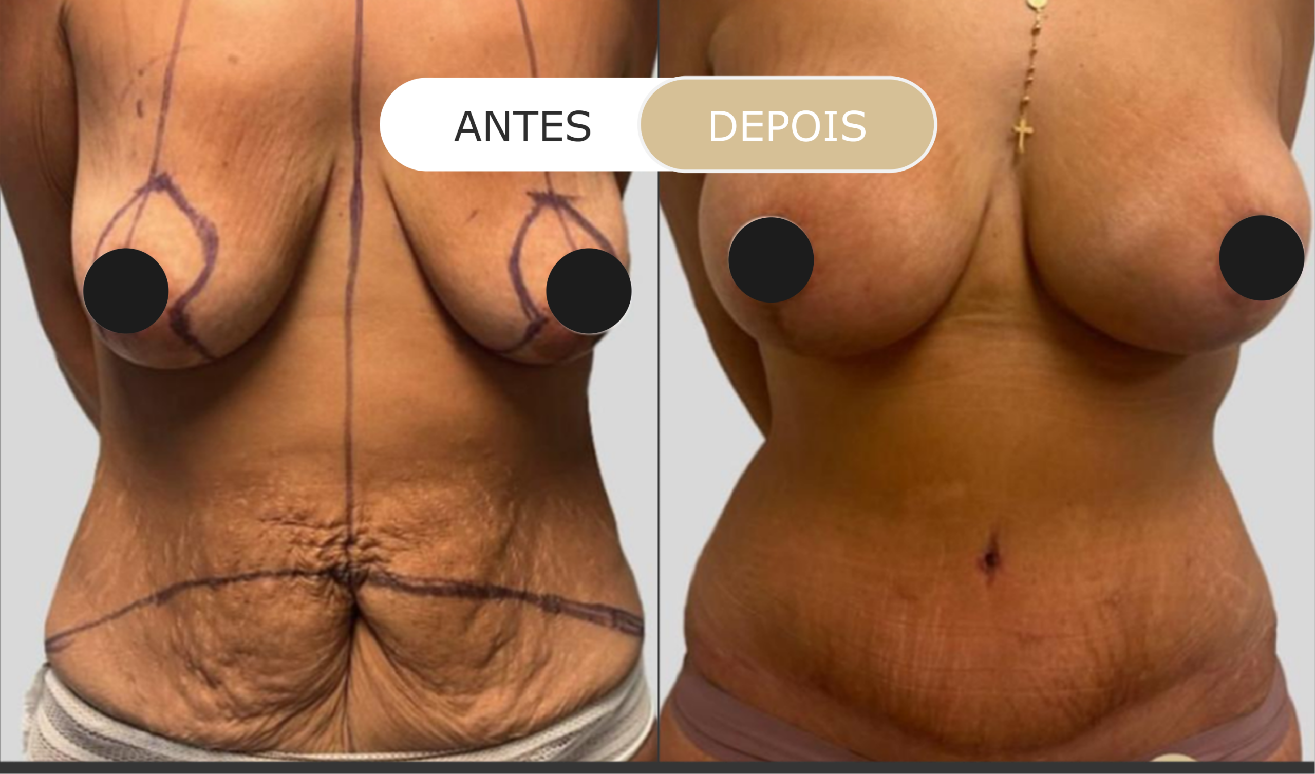 antes e depois - 32